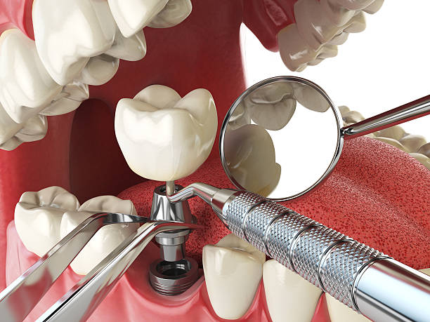 Best Emergency Root Canal Treatment in Glendale, MO